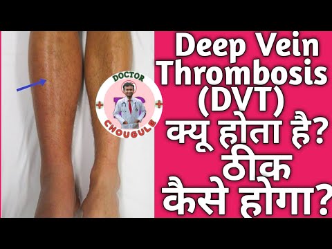 DVT क्यू होता है?  सही ईलाज क्या है?  Everything about deep vein thrombosis explained!  हिंदी मे ।
