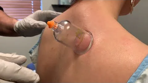 Cupping Therapy for Neck and Back Pain @prochiropractic - DayDayNews