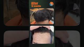 Grade 6 Baldness to Natural-Looking Hair | 4,000 Grafts Hair Transplant in Delhi