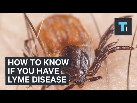 How to know if you have Lyme disease