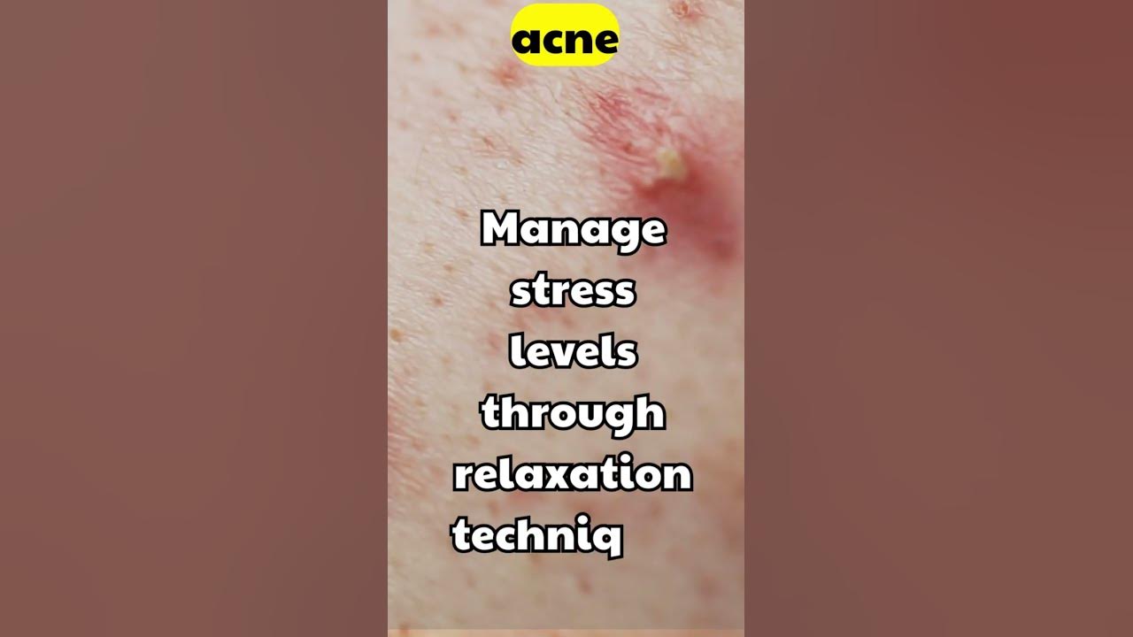 acne-breakouts-tea-tree-oil-for-acne-treatment-of-cystic-acne-treatment