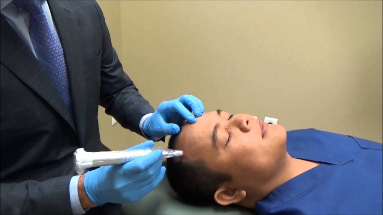 Microneedling With Platelet Rich Plasma For Hair Loss Dr