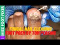 Fungal Nail cleaning | Foot Poem by Tom Perkins | Miss Foot Fixer