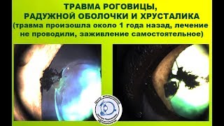 Травма роговицы, радужки и хрусталика у беспородной кошки Травма роговицы, радужки и хрусталика у беспородной кошки