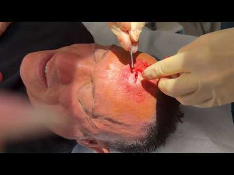 Dave Palumbo Has TUMOR Removed From Forehead!