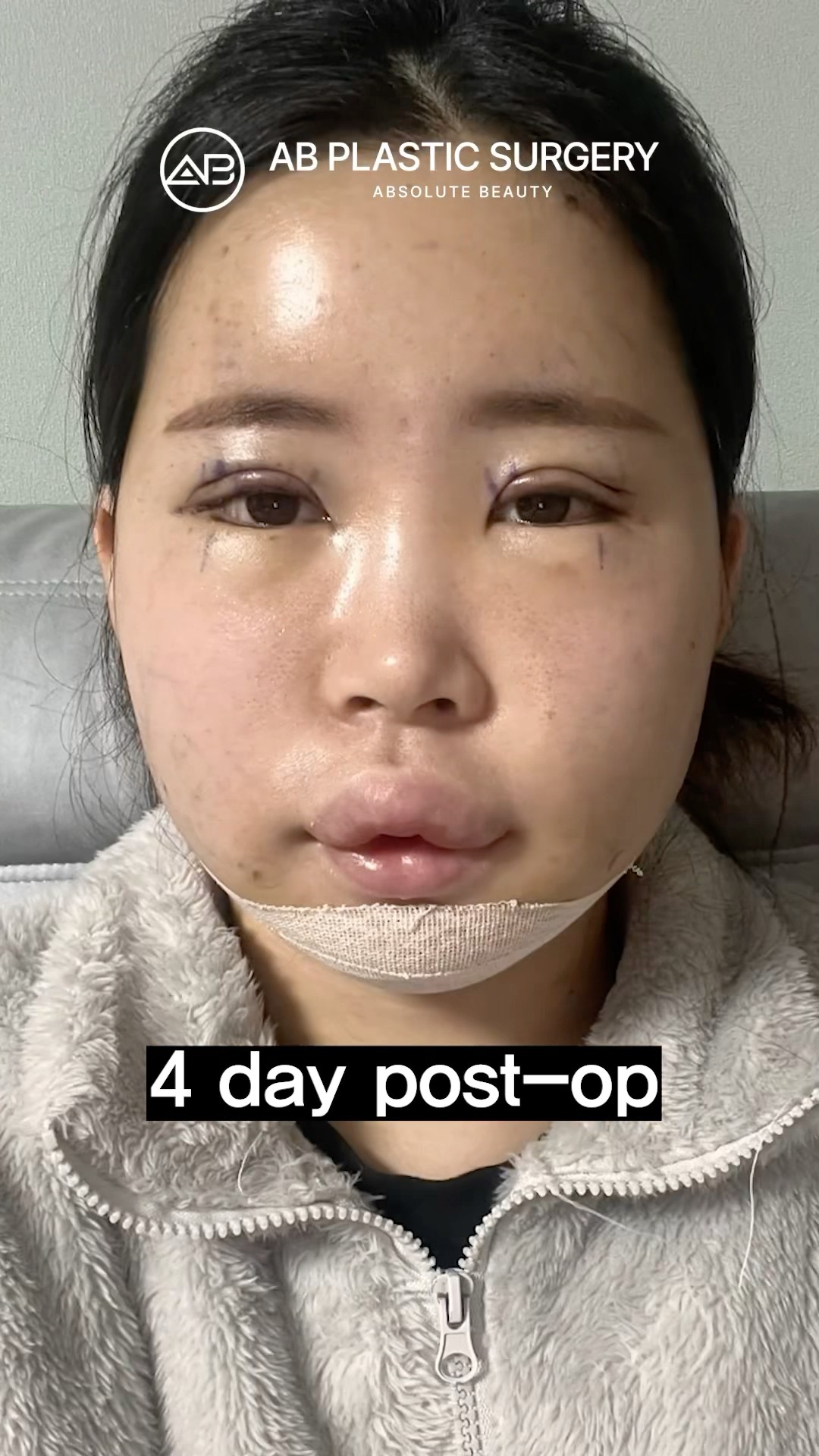Facial contouring+Double eyelid surgery #koreanplasticsurgery