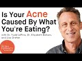 Is Your Acne Caused By What You're Eating?