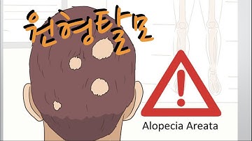 질환 리뷰 #4: 원형탈모, Alopecia areata (기능의학, 영양의학, 예방의학)