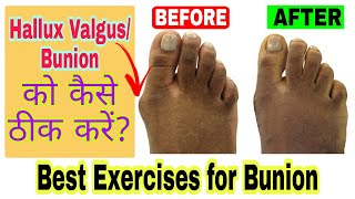 Hallux valgus correction exercises | Bunion exercises at home | per ke anguthe ki ganth ka ilaj