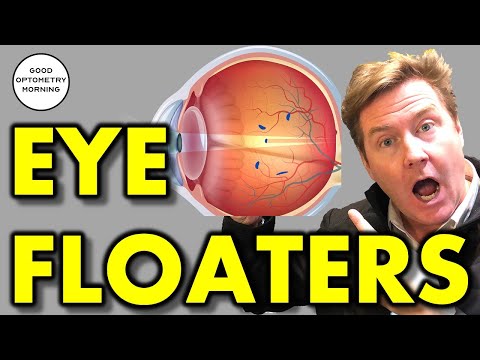 FLASHES & FLOATERS IN MY VISION: What does it mean & what should I do about it? Vitreous detachment