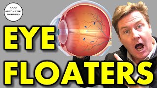 FLASHES & FLOATERS IN MY VISION: What does it mean & what should I do about it? Vitreous detachment