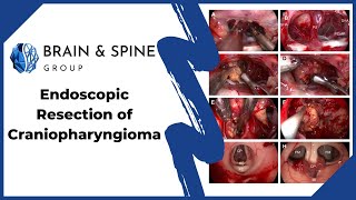 Endoscopic Resection Of Craniopharyngioma