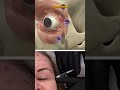 Simple Crow’s Feet Toxin Technique