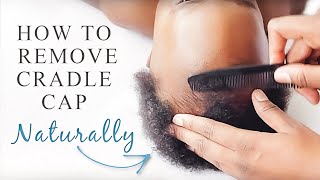 HOW TO GET RID OF CRADLE CAP NATURALLY | Step by Step cradle cap removal Tutorial