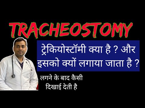 वीडियो: क्या आपको वेंटिलेटर पर रहने के लिए ट्रेकियोस्टोमी की आवश्यकता है?