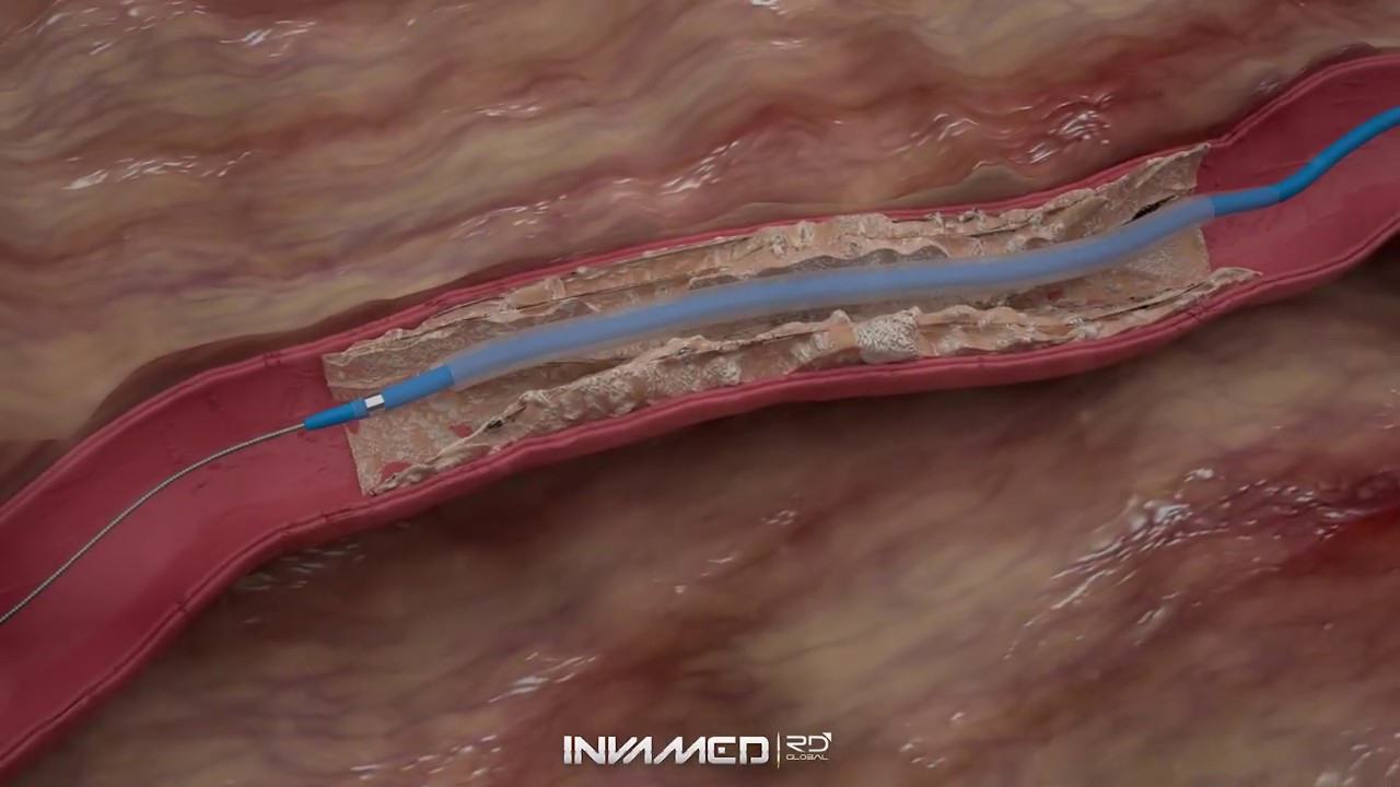 EXTENDER®️ Paclitaxel Coated PTA Balloon Catheter YouTube