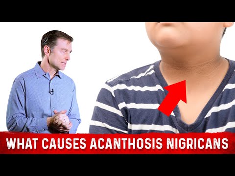 What Causes Acanthosis Nigricans (Darkened Skin Folds)