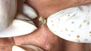 ACNE BLACKHEADS WHITEHEADS REMOVAL on face 38 | How to get rid of pimple easy part