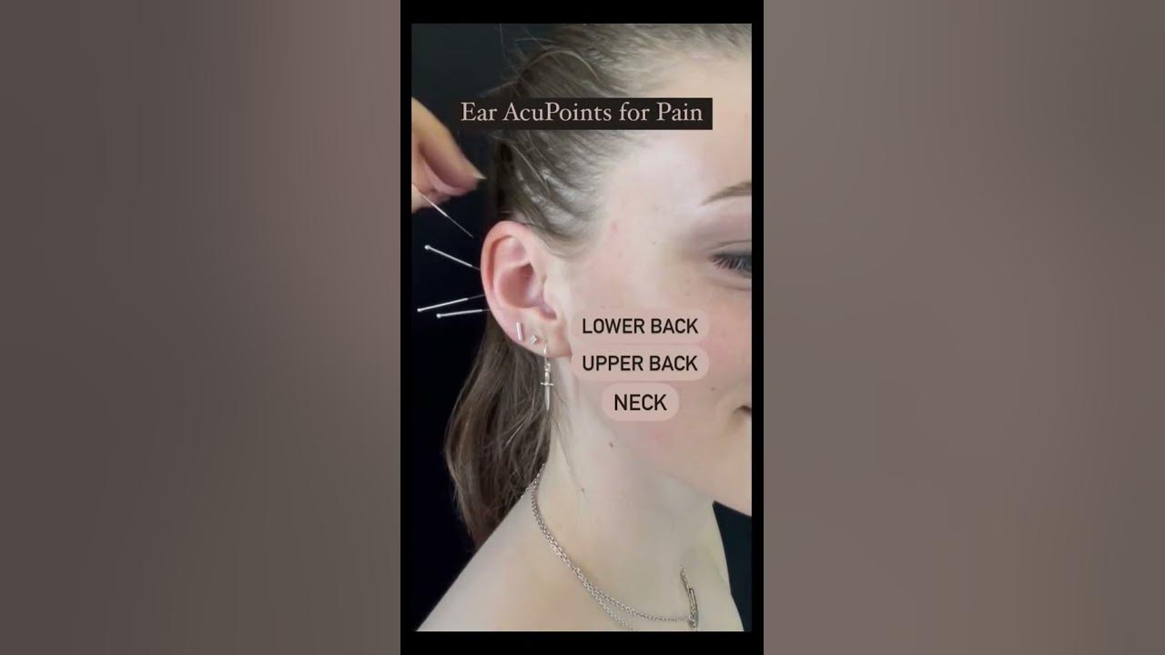 I Tried Ear Seed Acupressure For Lower Back Pain