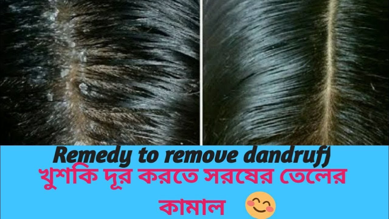 How to Remove dandruff Easy home remedy Using Mustard oil খুশকি