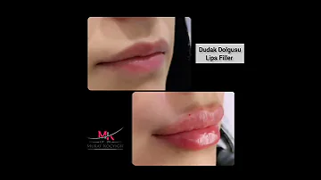 Dudak Dolgusu Uygulaması, Lips Filler Application