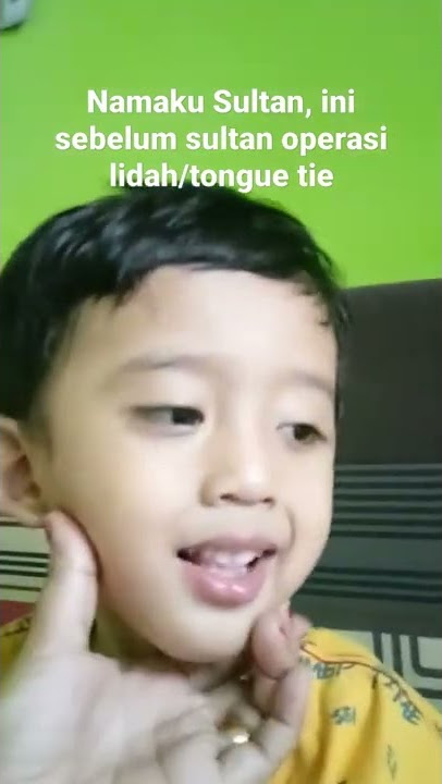 ini anakku, namanya Sultan, ini sultan sebelum operasi lidah/tongue tie.sehingga bicaranya cadel.
