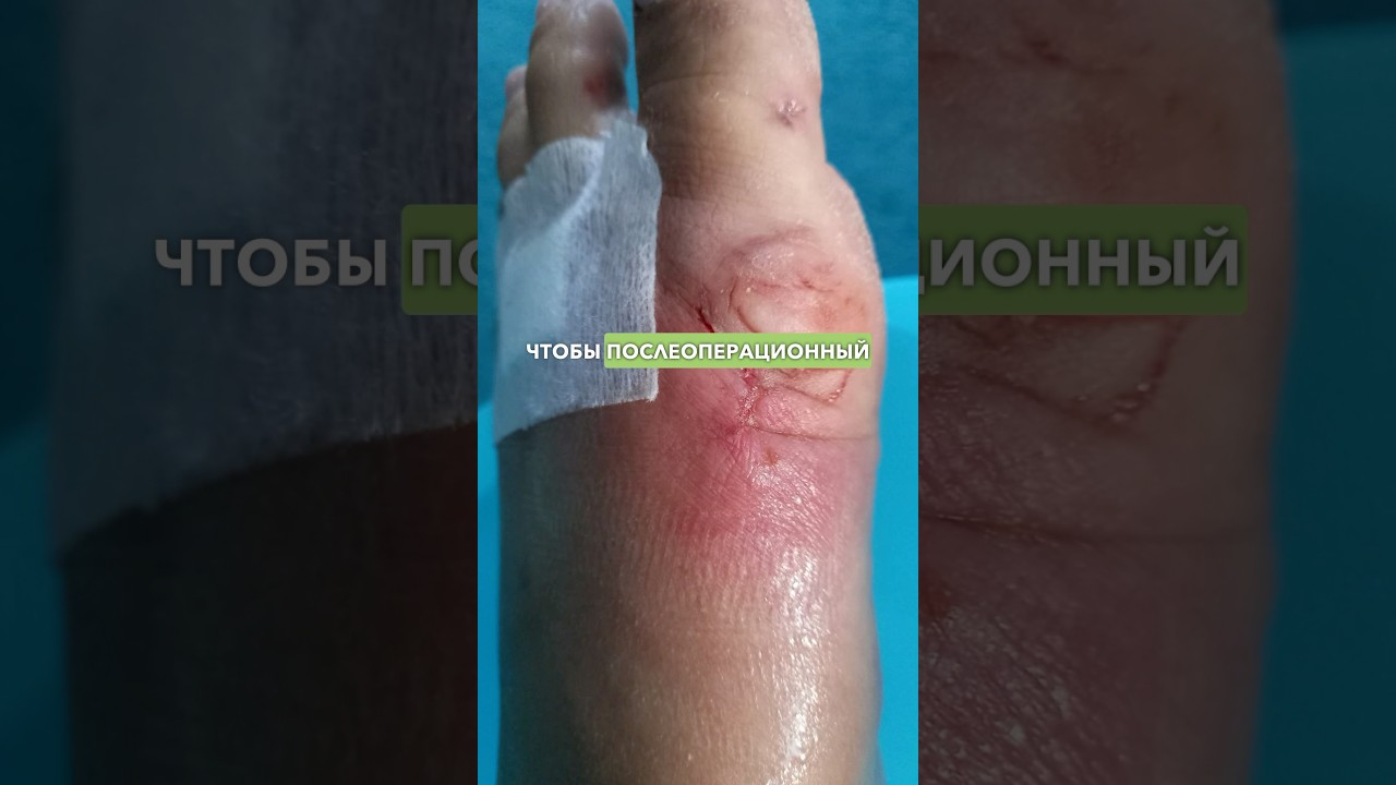 У нее был сильный отек после грации на стопе. Что делать?
