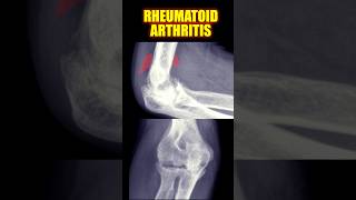 Rheumatoid Arthritis #arthritis #radiology #doctor