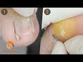 #1 Difficult to access inverted-edge nails | #2 Corns and calluses || 2 cases 1 video (VIII)