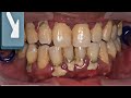 Dental Scaling Tartar Removal 