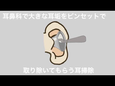 【ASMR】耳鼻科で大きな耳垢をピンセットで取り除いてもらう耳掃除 Ear Cleaning 【No Talking】