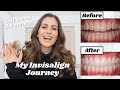 TEETH JOURNEY | Full Break down -Invisalign, Bonding, Whitening, Aftercare... Is it worth it?!