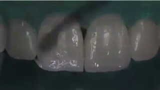 Închiderea Diastemei Prin Faţete Din Compozitdiastema Closure With Composite Veneers