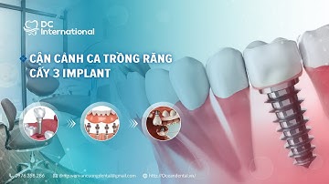 Cận cảnh ca trồng răng cấy 3 implant by Dr Cường