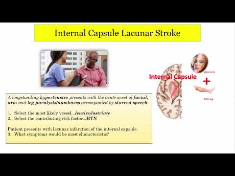 Video: Lacunar Stroke: Symptomer, Behandlinger Og Langtidsutsikter