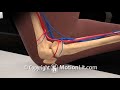 Knee injury popliteal artery laceration  motionlit animation