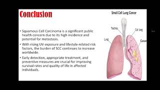 Tumors of Lungs | Types, Pathogenesis, Clinical Features & Management #pathology #disease #medical