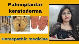 Thickening of skin !! Palmoplantar keratoderma symptoms,causes & homeopathic medicine !! Skin crust