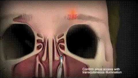 Gaymarit - Sinusdan yiringni olib tashlash. | Haymaritis is the removal of pus from the #health