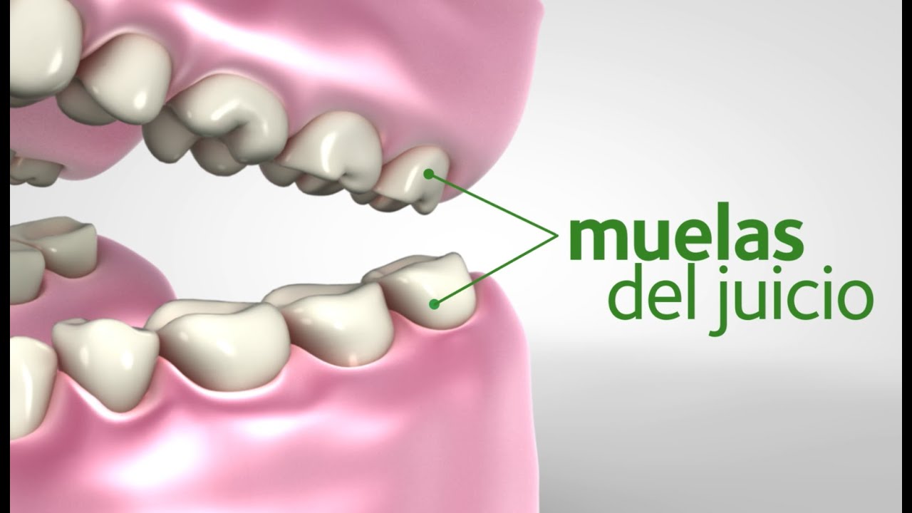 ligar la muela del juicio duele cuando sale