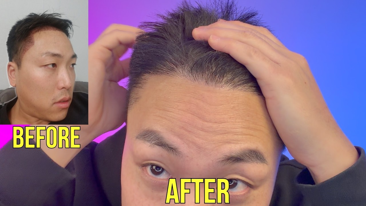 ЛУЧШЕЕ ПРЕДЛОЖЕНИЕ ПО ПЕРЕСАДКЕ ВОЛОС В 2026 ГОДУ?!