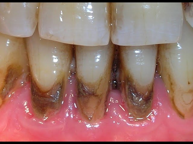 Sarro dental, calculo o tártaro