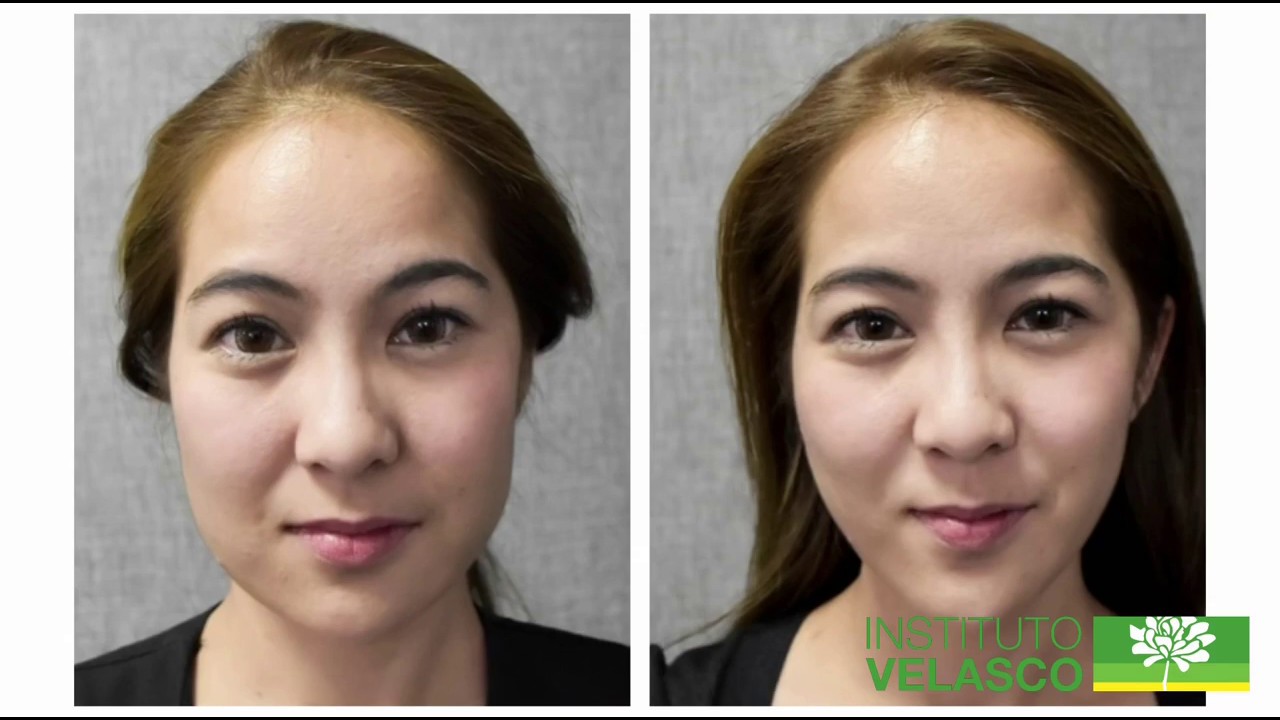 Parte 7 - Análise das Gorduras faciais