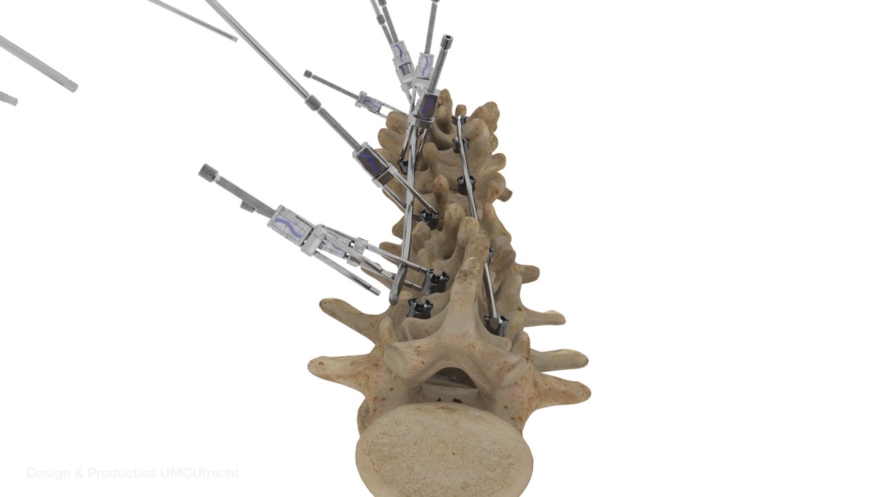 Scoliose operatie Mobility Clinic UMC Utrecht