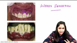 Acute Necrotising Ulcerative Gingivitis ANUG ( NEET MDS )