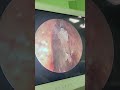 Шейверная полипэтмоидотомия справа