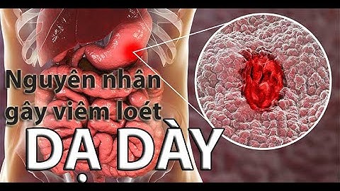 Nguyên nhân gây viêm loét dạ dày
