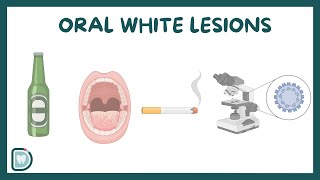 Understanding Oral White Lesions: Causes, Risks, and Management | Oral Health Guide screenshot 1