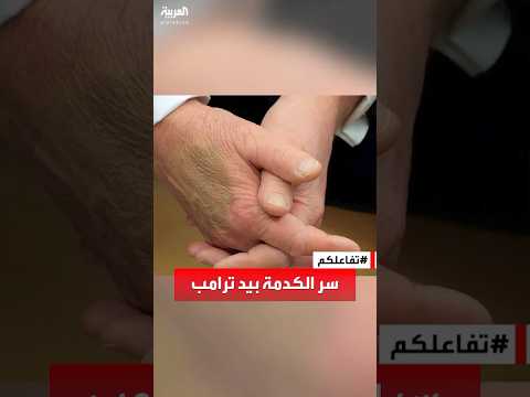 تفاعلكم سر كدمة زرقاء على يد ترامب