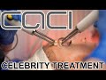 CACI facial - The secret celebrity treatment